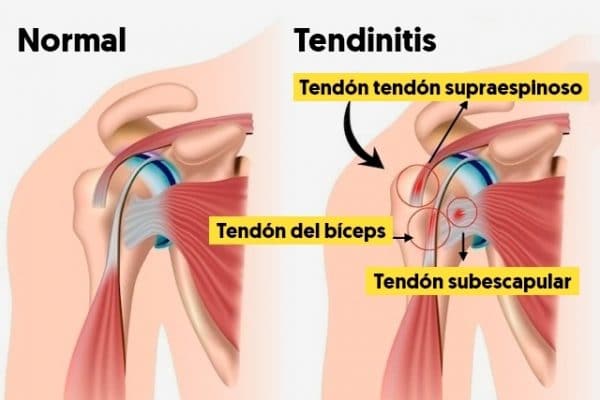 TENDINITIS DEL SUPRAESPINOSO FisioForm